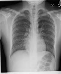 Bacterial pneumonia is an infection of your lungs caused by certain bacteria. Pneumonia Radiology Reference Article Radiopaedia Org