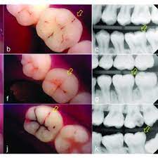 Zur seitennavigation oder mit tastenkombination (accesskey und taste 1). Pdf Detection Of Dental Caries And Cracks With Quantitative Light Induced Fluorescence In Comparison To Radiographic And Visual Examination A Retrospective Case Study