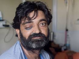 Indian doctors record a huge spurt in cases of mucormycosis, an aggressive mucormycosis, also known as black fungus or zygomycosis, is caused by a group of mould called mucormycetes. Why Black Fungus Aggravates Covid 19 Crisis In India Special Reports Gulf News