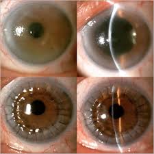 Bizi youtube ve instagramdan takip etmeyi unutmayın!!. Kornea Nakli Ankara Keratoplasti Prof Dr Yonca Akova