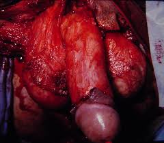 Anorectal, genitourinary, and traumatic infections are the most common causes of fournier's gangrene. Infection Fournier S 2649 Fourniers Gangrene 3 Surgery Photos