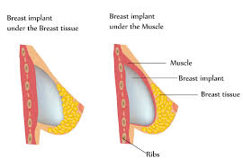 Check spelling or type a new query. Breast Implant Placement Over Vs Under The Muscle