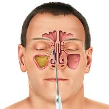 New Sinuplasty Surgery Uses Sinus Balloon To Treat Chronic Sinus Infections Illustration From Entellus Medical Chronic Sinusitis Sinusitis Sinus Remedies
