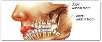 A small sip at a time can help to make sure that the drink does not get into the. Wisdom Teeth Removal Los Angeles Tooth Extraction Los Angeles