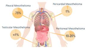 The pancreas is an organ that releases enzymes involved with digestion, and hormones to regular blood sugar levels. Pleural Mesothelioma V Lung Cancer Asbestos Justice