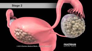 Common symptoms of ovarian cancer include bloating, pelvic pain, feeling full quickly, and urinary symptoms. Ovarian Cancer Youtube
