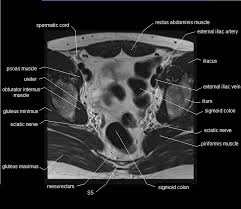 The male pelvis anatomy model is shown in median section. Mri Pelvis Anatomy Free Male Pelvis Axial Anatomy