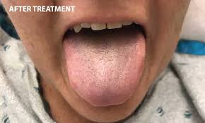Image result for black tongue symptoms