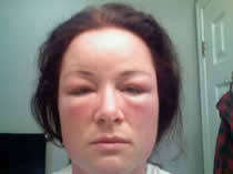 Imgur user thechosenginger chronicled the first five days of her friend's allergic reaction. Hair Dye Reaction To Ammonia Free Hair Dye Renaissance Henna