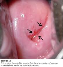 Prnjelasan akhlak secara lengkap akan dibahas dalam artikel ini. Condyloma Acuminata Adalah A Fi Simplu ReprezintÄƒ Deci O SavantÄƒ Intoarcere La NevinovÄƒÅ£ie