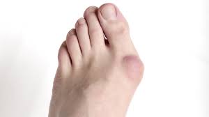 Not only can this help relieve inflammation by prompting a with bunions, a firm, painful bump develops at the base of the big toe, sometimes. Foot Pain And Problems Johns Hopkins Medicine