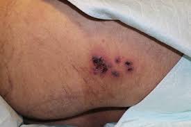 Mucormycosis is a rare, severe infection with fungi of the order mucorales. Fungal Infections In The Pediatric Age Group Springerlink