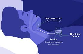 Image result for Sleep Apnea