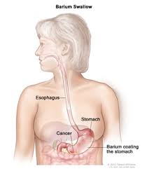 Stomach cancer is an abnormal growth of cells that begins in the stomach. Gastric Cancer Treatment Pdq Treatment Patient Information Nci Cs Mott Children S Hospital Michigan Medicine