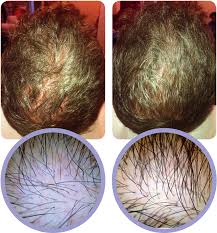 Androgenetic alopecia/female pattern alopecia/female pattern hair loss (fphl)/baldness: Download Androgenic Alopecia A Prp Injections Are Simple And Prp Hair Before And After Png Image With No Background Pngkey Com