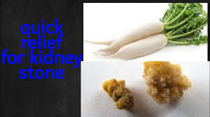 Kidney Stone Pain Quick Relief Diet Urdu Hindi Youtube