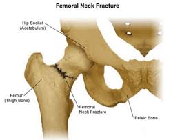 Similarly in computer networks a backbone network is as a network containing a high capacity connectivity infrastructure. Types Of Hip Fractures Stanford Health Care
