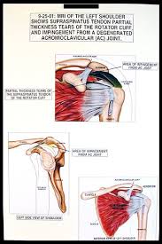 Howell Medigraphics Medical Illustration Of The Month Medical Illustration Medical Shoulder Anatomy