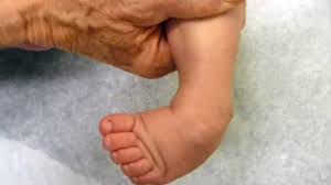 Club foot can't be treated before birth, but picking up the problem during pregnancy means you can talk to doctors and find out what to expect after your baby is born. Orthopedic Clubfoot Care Youtube