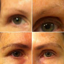 Bimatoprost is believed to affect the growth of hair follicles by increasing the per cent of hairs in the anagen (growth) phase of the hair cycle and increasing the duration of this phase. Cureus Topical Treatment Of Eyebrow Hypotrichosis With Bimatoprost 0 03 Solution Case Report And Literature Review