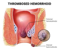 Image result for hemoroid human