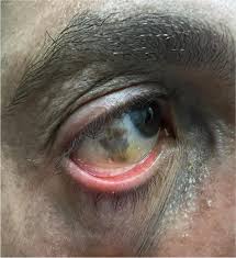Image result for melanosis sclera