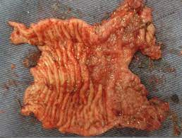 It can originate in the lymph nodes, bone marrow, or organs like the spleen. Scielo Brasil Papillary Adenocarcinoma Of The Descending Colon In A Dog Case Report Papillary Adenocarcinoma Of The Descending Colon In A Dog Case Report