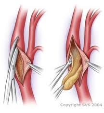 Endarterectomy Vascular Ultrasound Vascular Surgery Carotid Artery