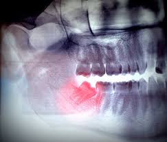 Wisdom teeth or third molars are the last teeth to come through and are considered to be a frequent cause of oral problems for many people across the globe. Dr Craig Greeff Wisdom Teeth Removal