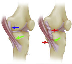 David rubin and robin smithuis. Mri Findings Of Stener Like Lesion Of The Knee A Case Series With Surgical Correlation European Journal Of Radiology