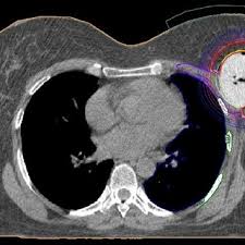 During a breast mri , you lie on your stomach on a padded scanning table. Breast Cancer A Ct Scan After Breast Conserving Surgery Before Download Scientific Diagram