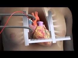 Sternotomy Open Heart Surgery 3d Animation Youtube Open Heart Surgery Heart Surgery Cardiac Nursing