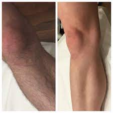Looking for laser hair removal in the northern suburbs of melbourne? Laser Hair Removal Melbourne Box Hill Lose It With Laser