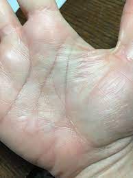 Miracle Cure For Burns Delightful Delicious Delovely