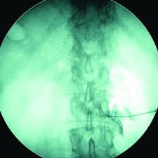 Wie jeder teil der wirbelsäule wird auch die lendenwirbelsäule von sehnen und. Pdf Injektionsverfahren Im Bereich Der Lendenwirbelsaule