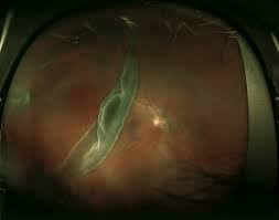 The vast majority of retinal tears are treated with laser photocoagulation. Retinal Detachment Detection And Segmentation Algorithm By Rsip Vision