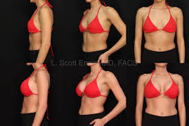 Breast Implant Size Guide In By Ennis Plastic Surgery In