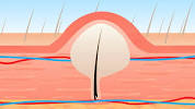 Inner Thigh Ingrown Hair Cyst