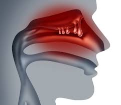 Nasal polyps