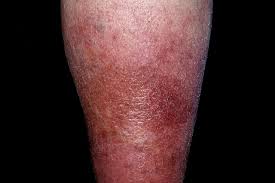 Related online courses on physioplus. Cellulitis Symptoms Hot Burning Red Tender Skin On Your Lower Legs
