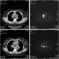 It often occurs in the lungs and lymph nodes, but it can occur in almost any organ. Sarcoidosis Misdiagnosed As Malignant Tumors A Case Report World Journal Of Surgical Oncology Full Text