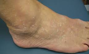 Surgery is the only reliable way to remove skin lesions. The Most Common Skin Lesions Benign With Pictures