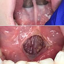 Lingual Frenectomy Wikipedia