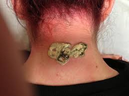 If you looking for tattoo removal instead of laser than salt and lemon juice is a perfect home remedy to get rid of the tattoo. Which Is The Best Tattoo Removal Method