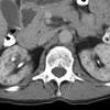 This inflammation can lead to kidney failure, but the course of the lupus and the pattern of its effects. 1