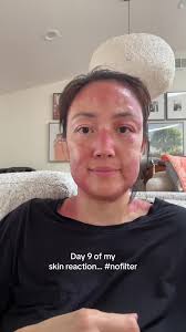 Understanding Skin Reactions: Day 9 Insight