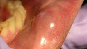 Image result for Mouth ulcers symptoms roof of the mouth