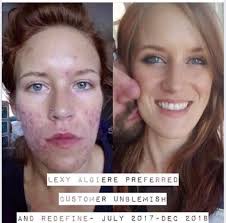 Acne-safe products and bi-weekly treatments for clear skin