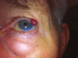 Image result for Merkel Cell Carcinoma