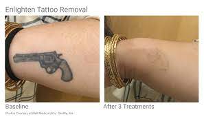The level of discomfort you will feel during the laser removal process will vary depending on the location, color and size of the tattoo. Pin By Well Medical Arts On Tattoo Removal Tattoo Removal Tattoos Tattoo Removal Results